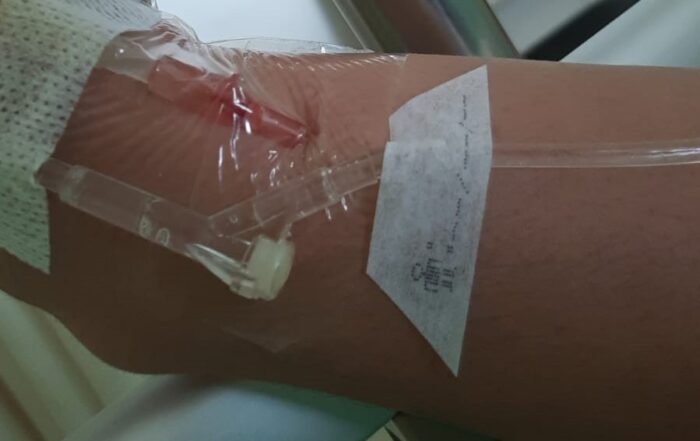 kondisi tangan sedang diinfus